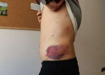 Kerem İmrak'ın vücudunda işkence izleri. Fotoğraf: ANF