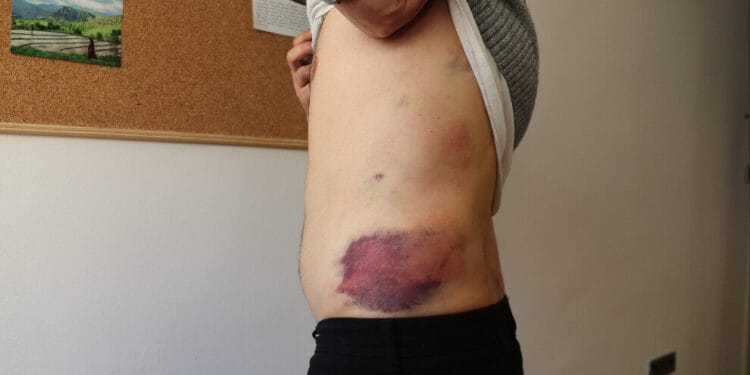 Kerem İmrak'ın vücudunda işkence izleri. Fotoğraf: ANF